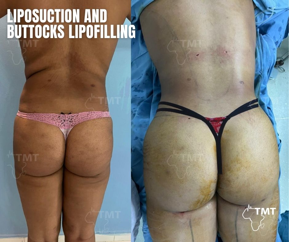 liposuction 45