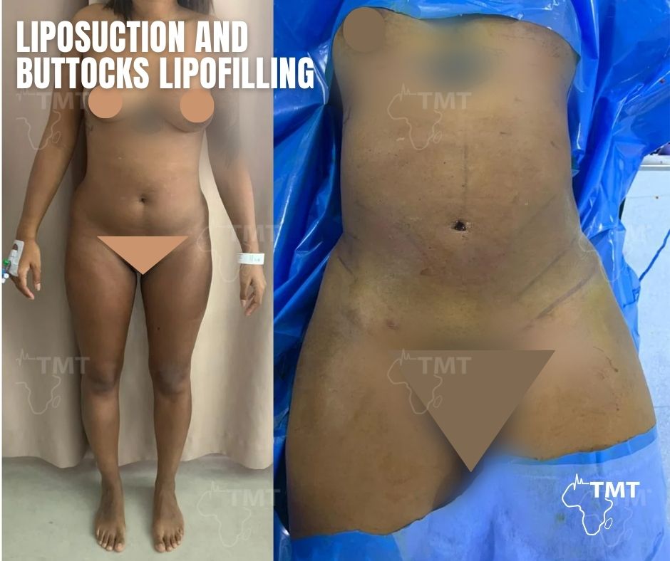 liposuction 5
