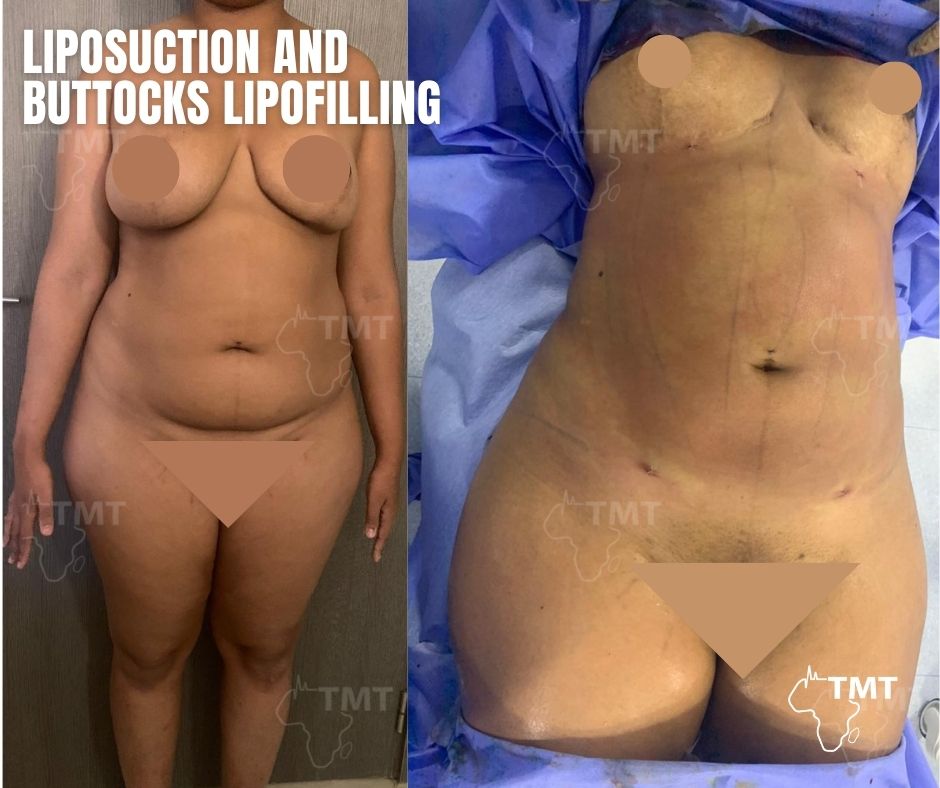 liposuction 7