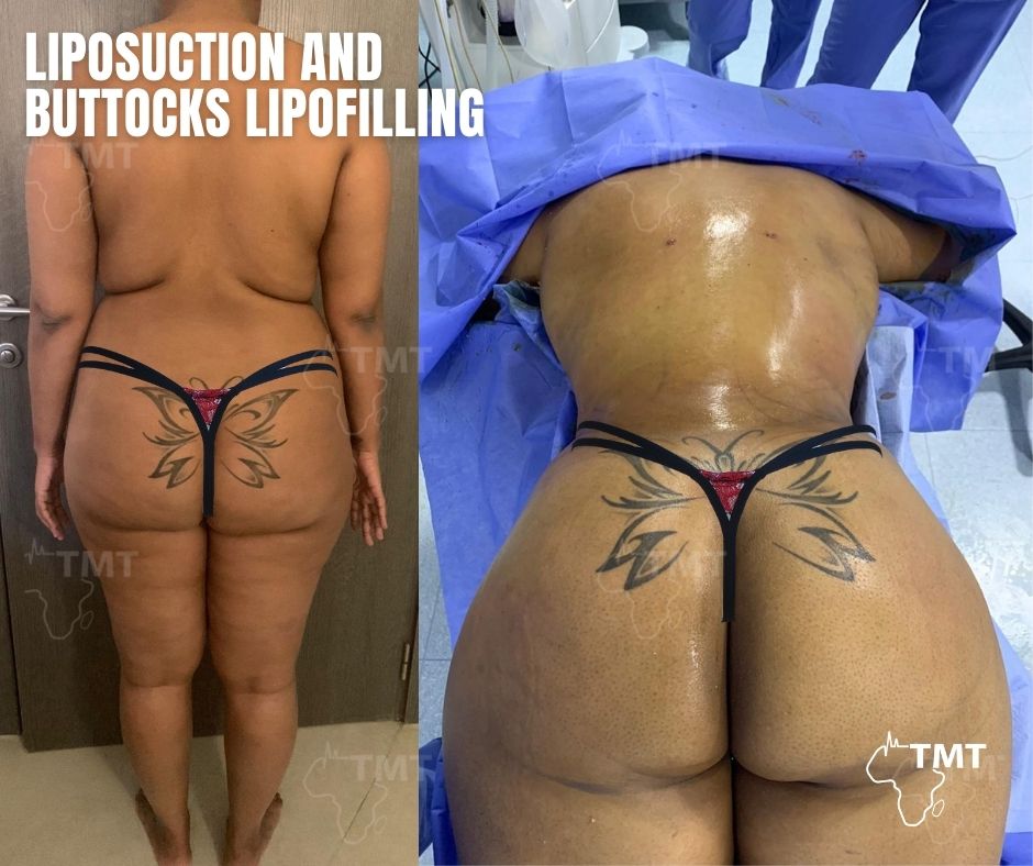 liposuction 8