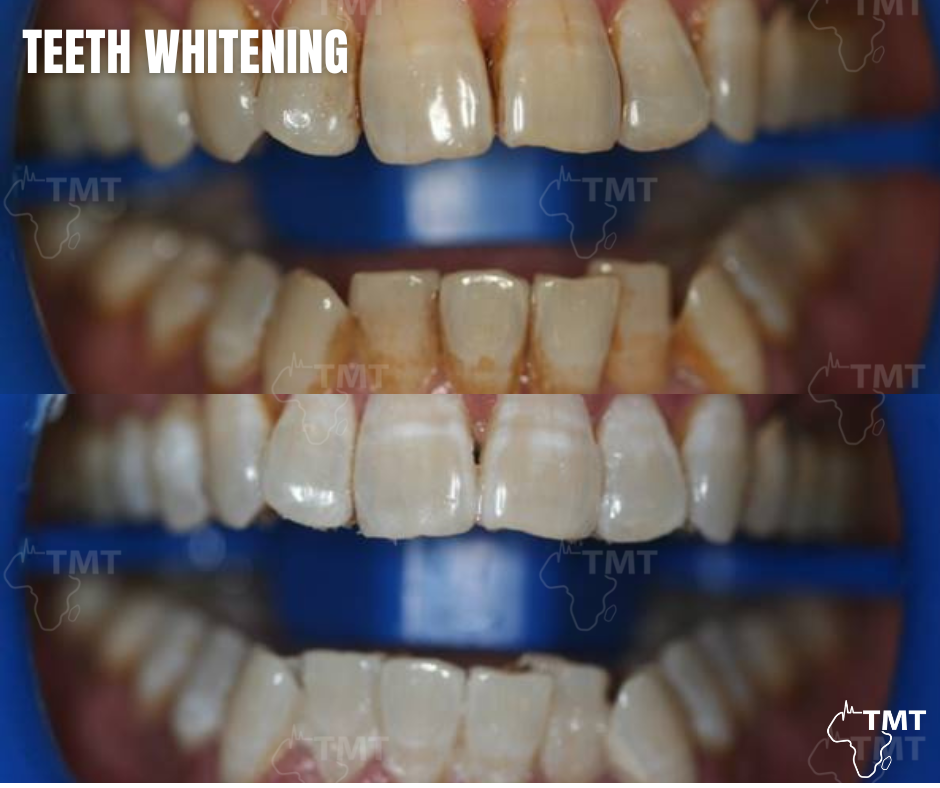teeth withening 2