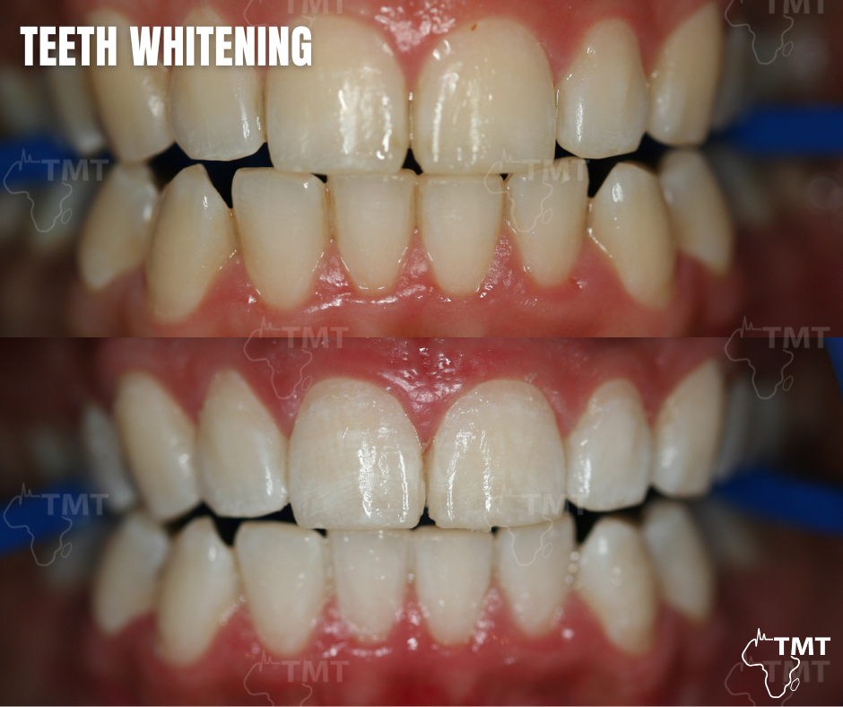 teeth whitening 3