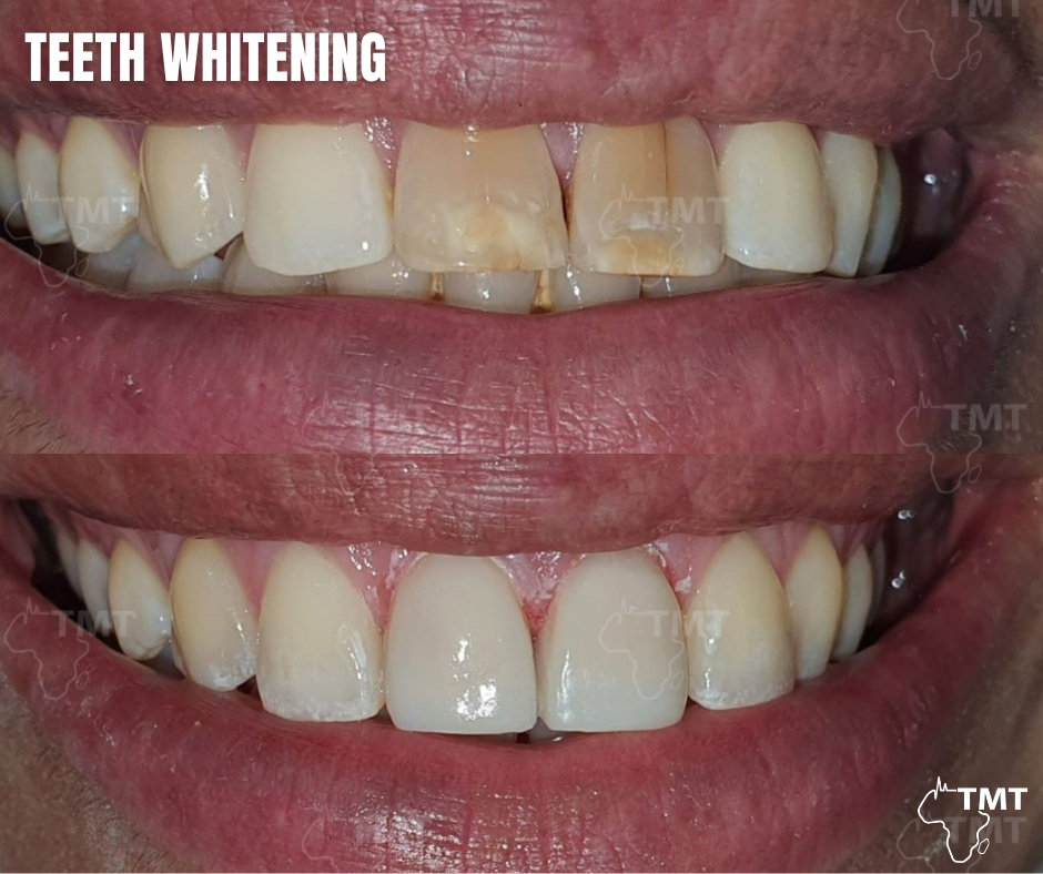teeth whitening 4