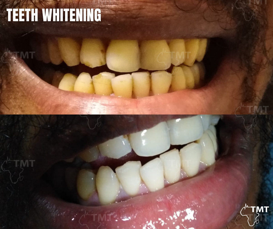 teeth whitening 5