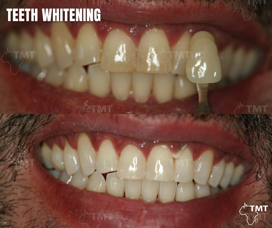 teeth whiteninh before after