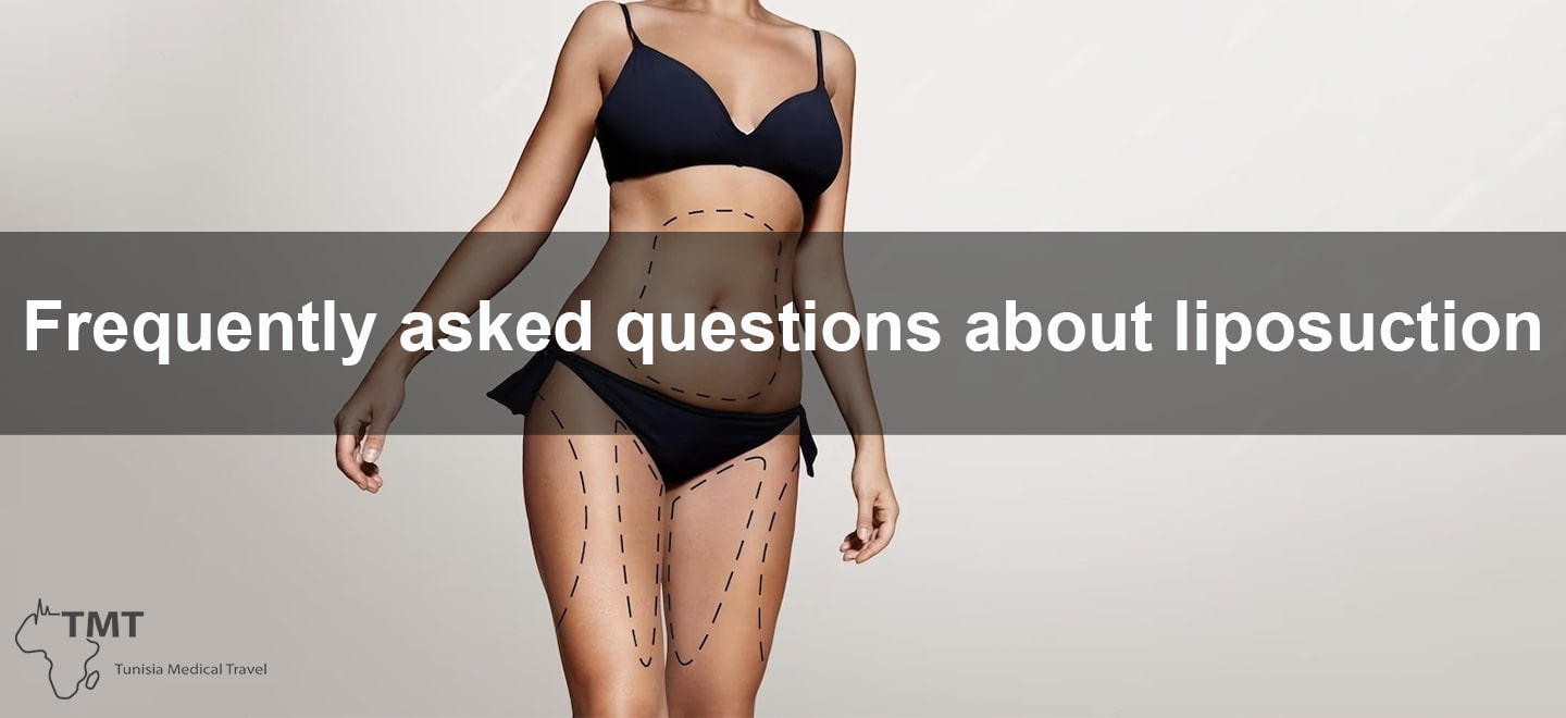 Liposuction questions