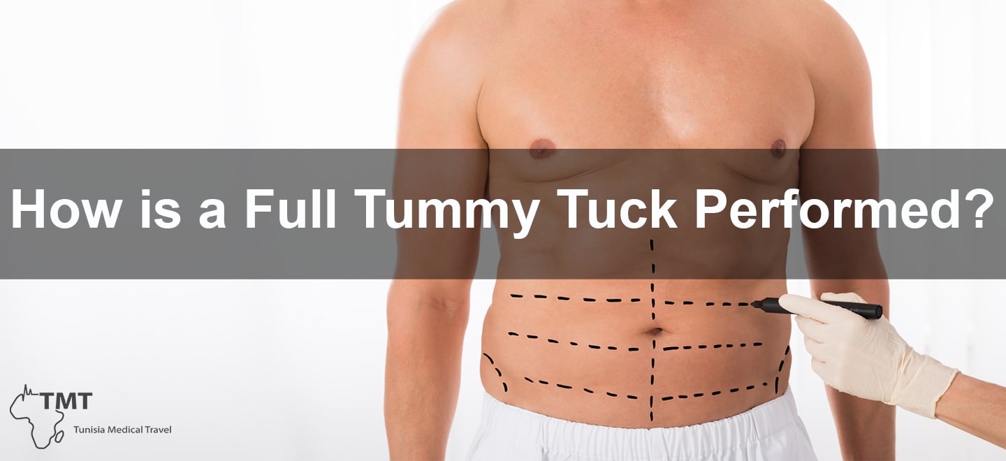Full tummy tuck