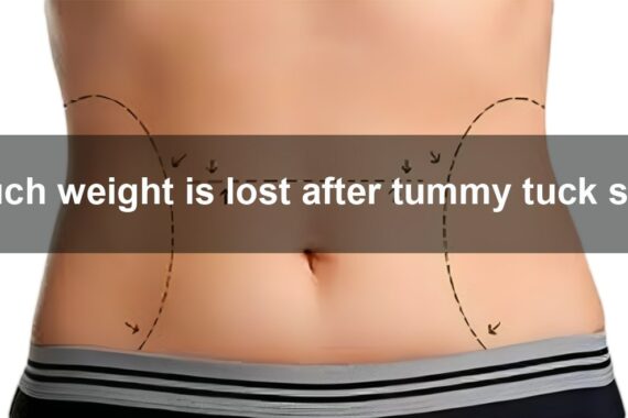 Weight loss tummy tuck