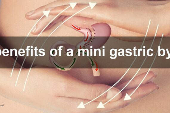 The mini gastric bypass
