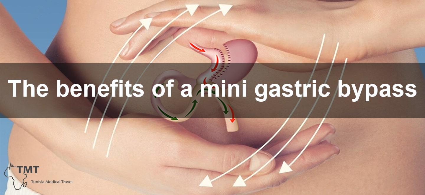 The mini gastric bypass