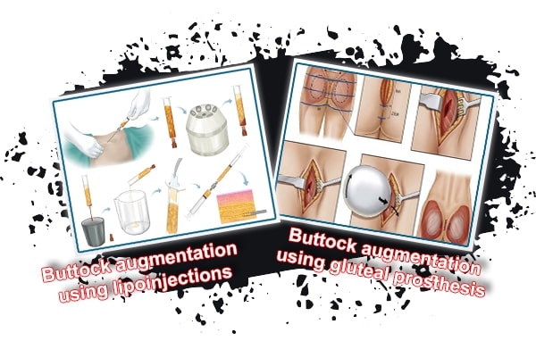 Buttock Augmentation