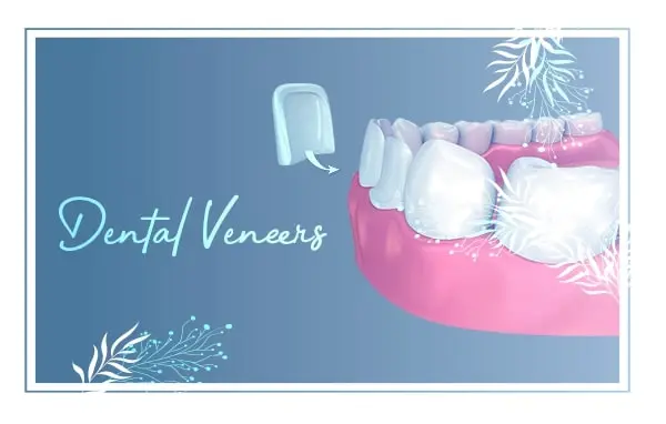 Veneers