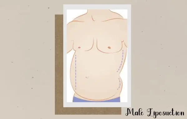 Male Liposuction